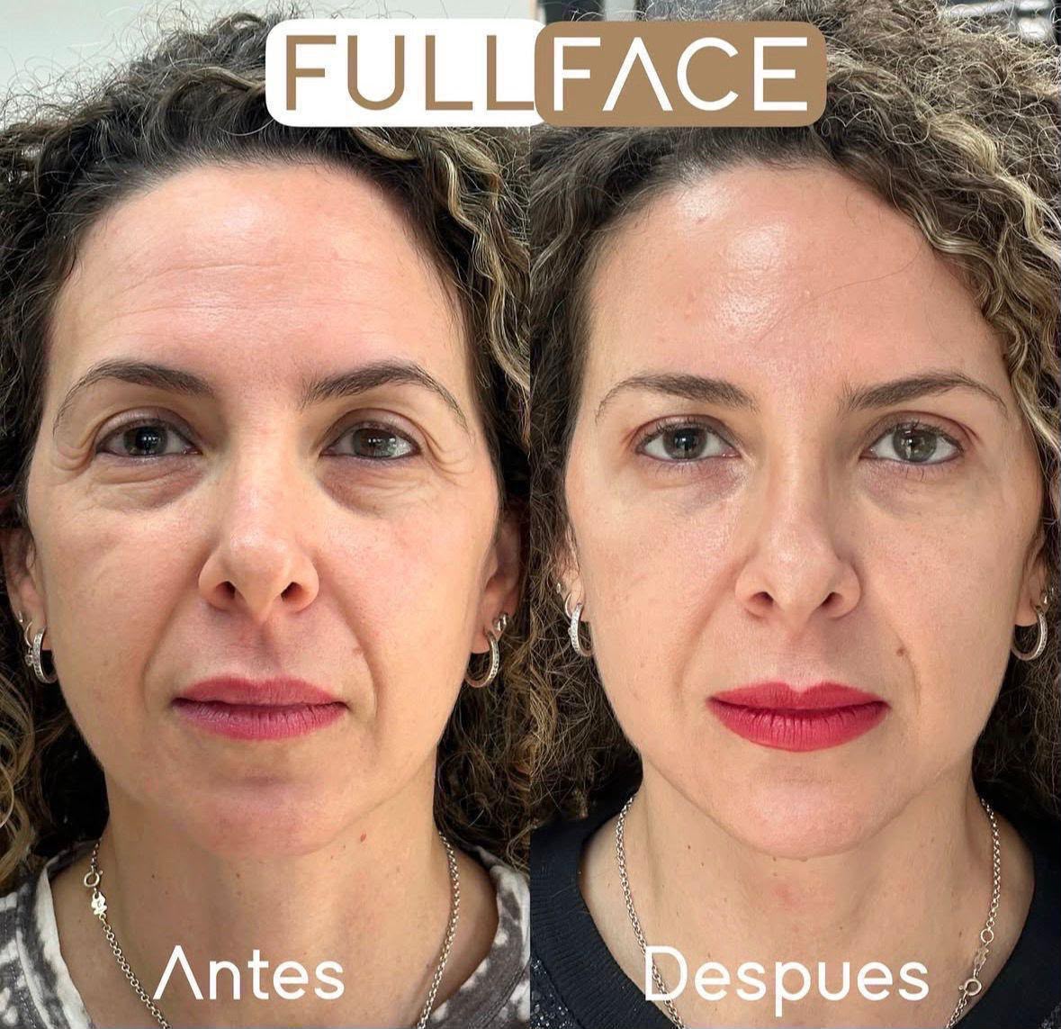Morpheus8 facial completo