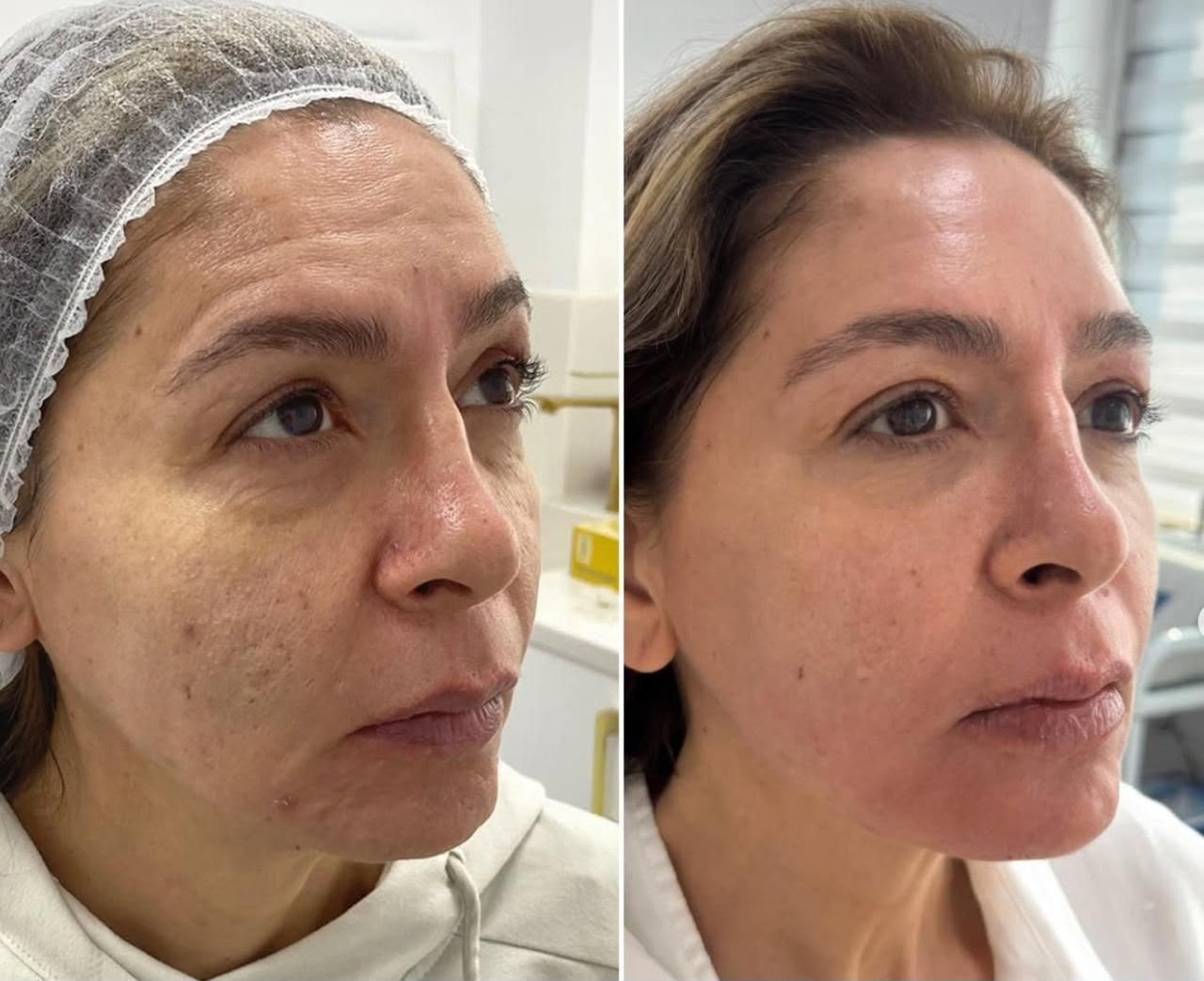 Botox / Dysport antifaz