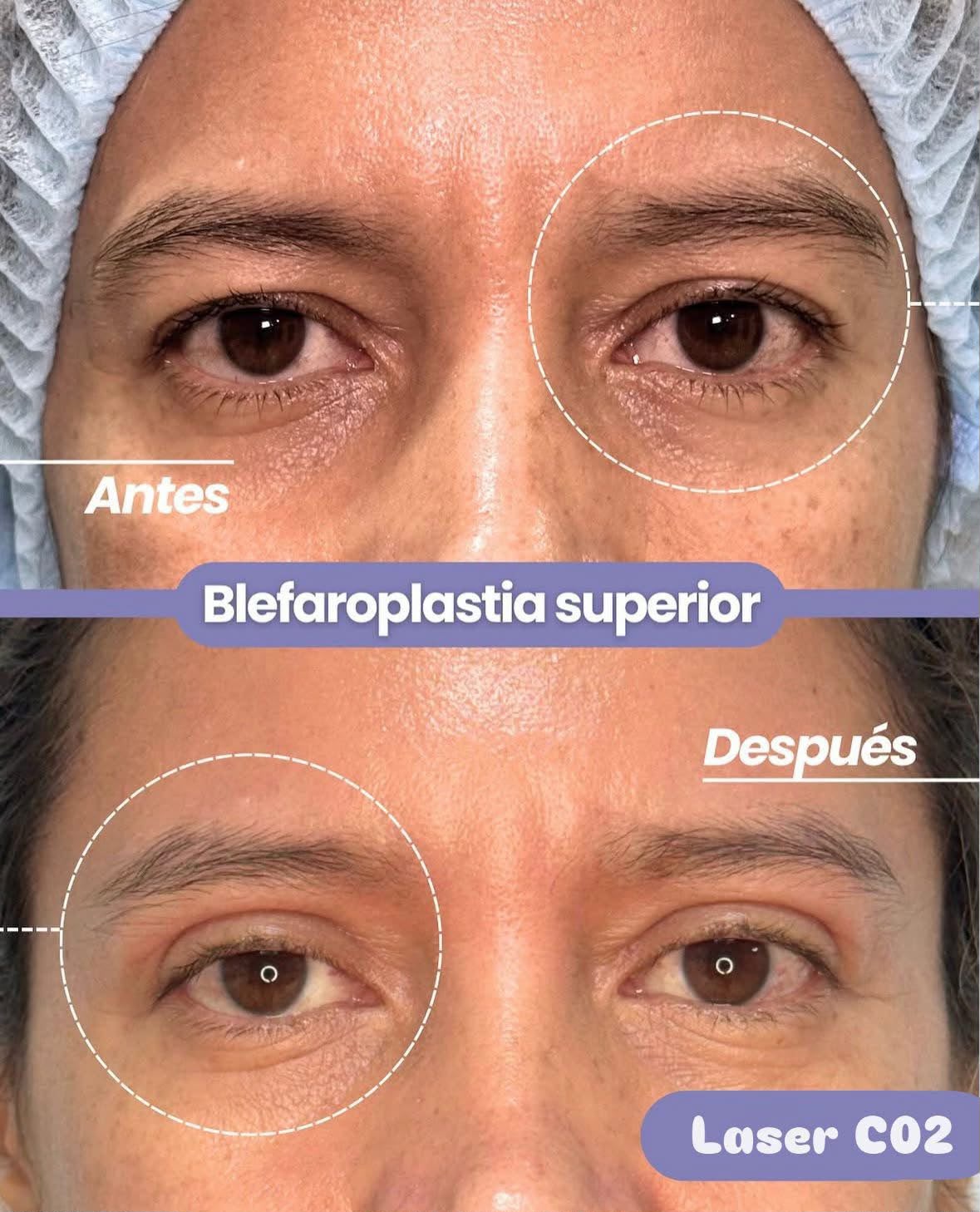Antes y después Blefaroplastia CO2 Párpados